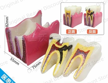 Diş İmplant Gösteri Modeli Diş Çalışma Öğretmek Hastalığı Analizi Çürümüş diş Maksiller Mandibular ayrılabilir